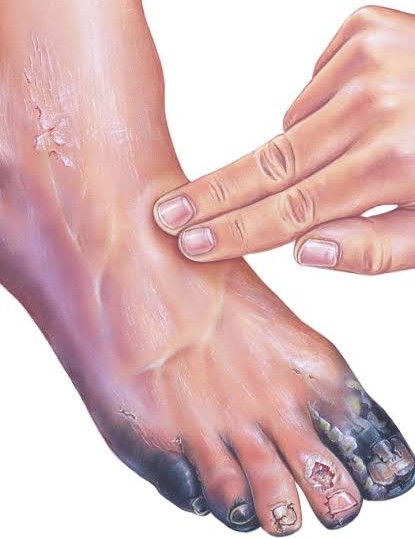 Gangrene Treatment