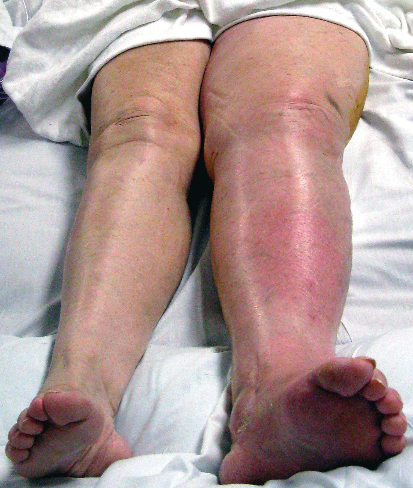 Deep Vein Thrombosis